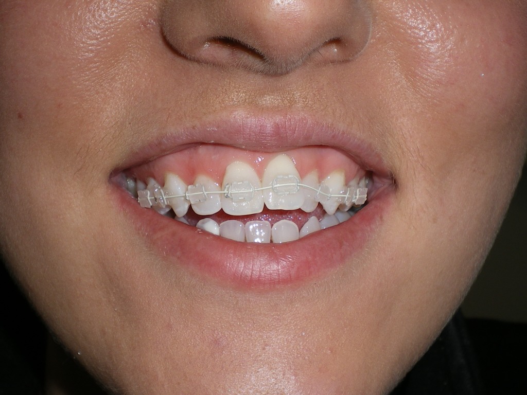 Searching for the ideal white brace. Wexford Orthodontics