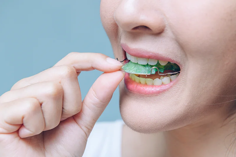 Removable Braces